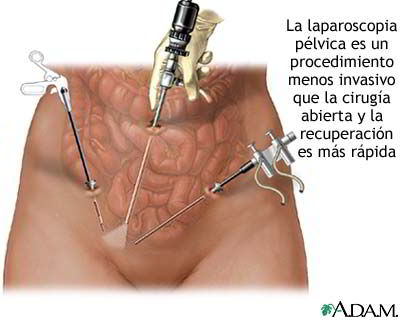 laparoscopia