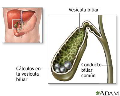 Vesícula con cálculos biliares