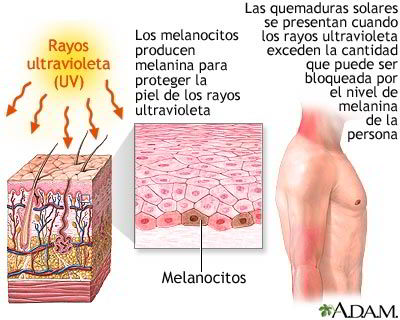 Quemadura solar