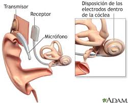 Implante coclear